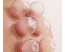 آموزش حجامت و طب سوزنی