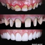 دندانپزشکی کامپوزیت دندان