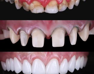 دندانپزشکی کامپوزیت دندان