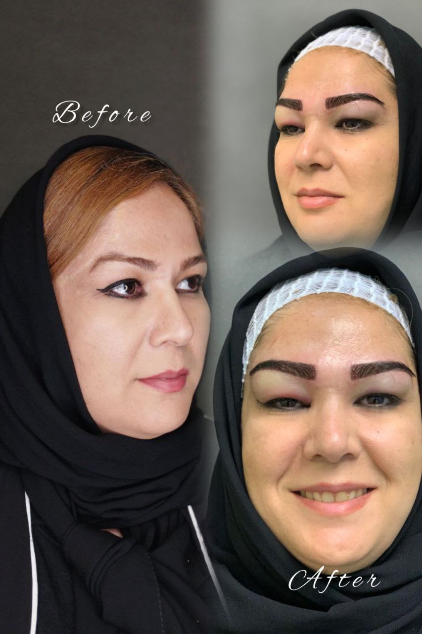 کلینیک کاشت ابرو
