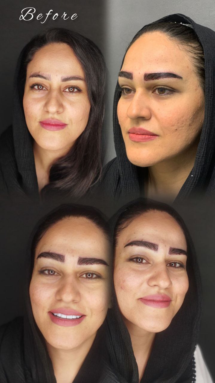 مرکز کاشت ابرو
