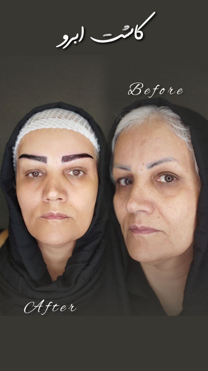 مرکز تخصصی کاشت ابرو