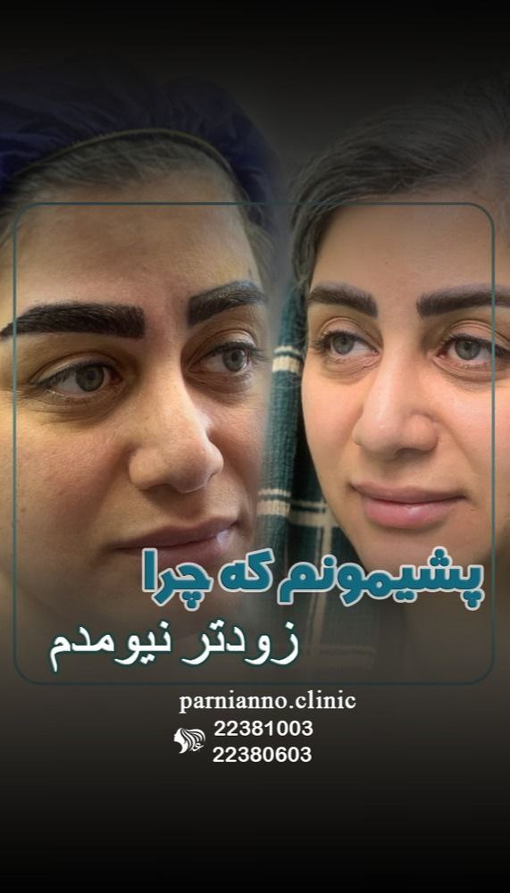 بهترین کاشت ابرو