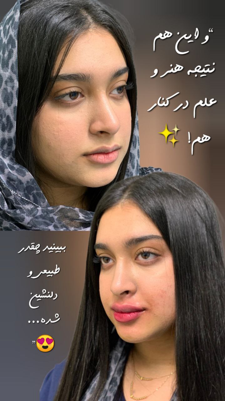کاشت ابرو