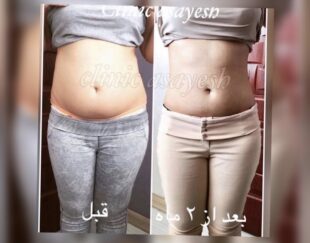 لاغری بدون جراحی با کرایولیپولیز