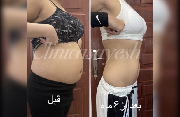 لاغری بدون جراحی با کرایولیپولیز